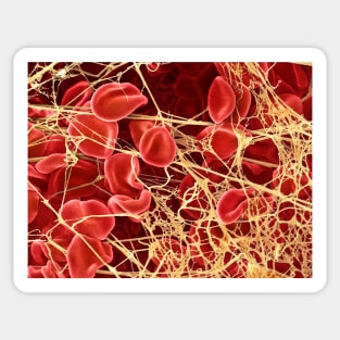 Blood clot, SEM (P260/0107) Sticker